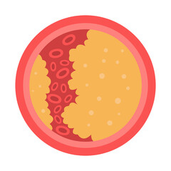 vessel with fat blocked blood flow