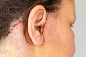 Naklejka premium Shot of the stitches and scars on woman head after cosmetic surgery. Healthcare