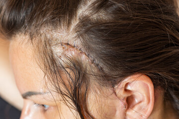 Shot of the stitches and scars on woman head after cosmetic surgery. Healthcare