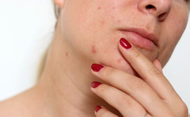 Obraz premium Close up of female face with red problematic acne skin and scars