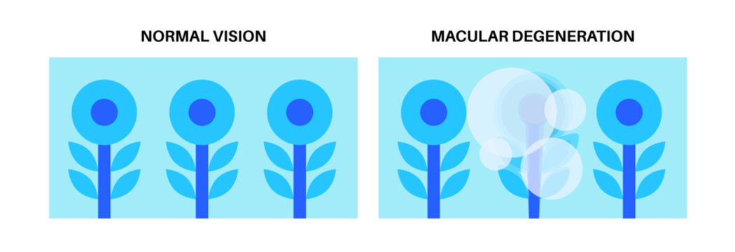 Macular degeneration poster