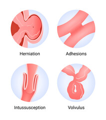 Symptoms and Causes of Bowel Obstruction