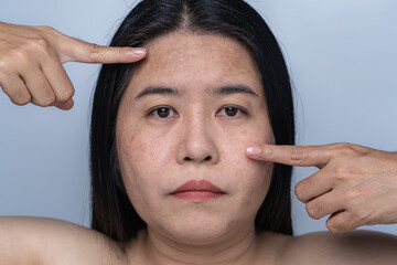 Woman with facial skin problems of freckles, dark spots, and wrinkles on the face Enlarged pores on combination skin Expressing a tense, thoughtful expression Dull and rough skin  Healthy concept.