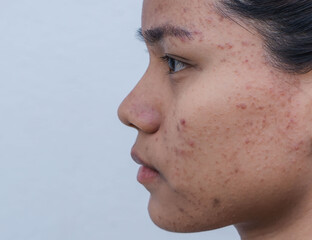 A woman with facial skin problems, inflamed acne, hormonal acne, and large pores on combination skin. Expressing a tense, thoughtful expression Dull and rough skin. Black hair. Healthy concept.