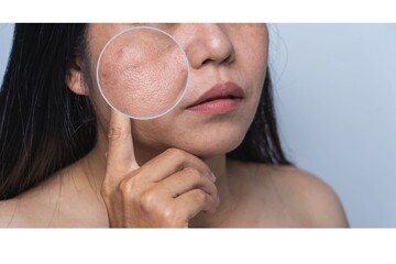 Women with facial skin problems such as blemishes, freckles, dark spots, uneven skin tone and large...
