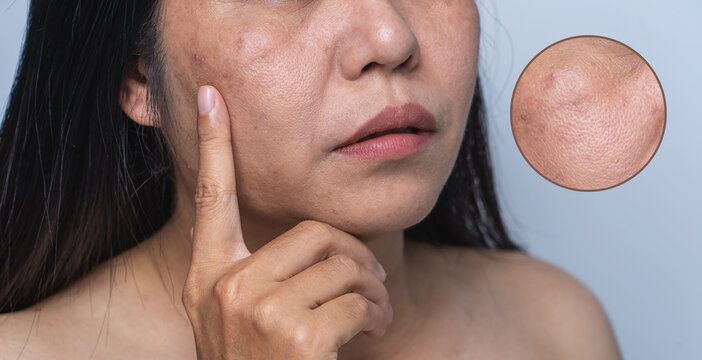 Enlarged circles indicate facial skin problems such as blemishes, freckles, uneven skin tone and large pores on combination skin. Dull and rough skin The concept of good health