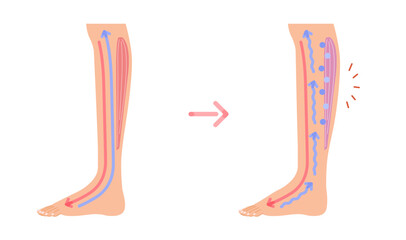 足のむくみ：むくみの発生原因イメージイラスト（断面図）