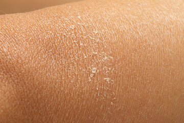 Dry human skin of a caucasian woman. Concept of skin rehydration cosmetics