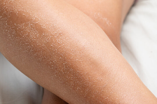 Detail of dry skin of woman legs. Dehydration due to the sun's rays.
