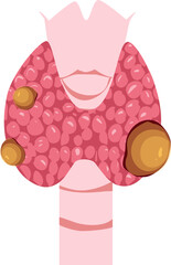 Thyroid disease Illustration 