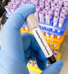 Scientist hold blood sample container with blood for Serum Fructose Qualitative test to diagnosis...