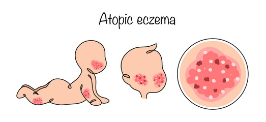 Atopic eczema