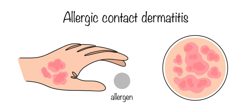 Allergic contact dermatitis