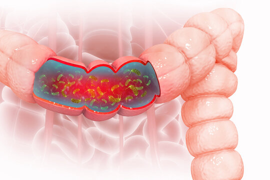 Visual concept of Bacterial infection of the colon, colon cancer. 3d illustration