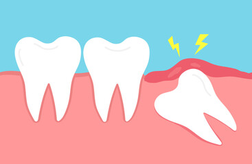 Impacted wisdom tooth. Crooked teeth. Toothache molar. inflamed and swollen gum. Dental care. Vector illustration