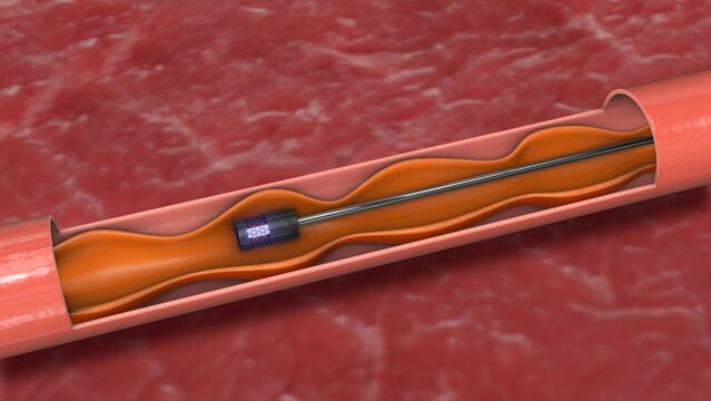Targeted Laser Ablation for Varicose Vein Relief