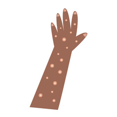 mpox, monkey pox disease. 