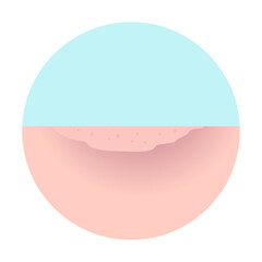 mpox, monkey pox disease. stage 6 healed of Mpox skin symptom