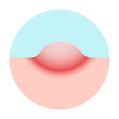 mpox, monkey pox disease. stage 3 vesicle of Mpox skin symptom