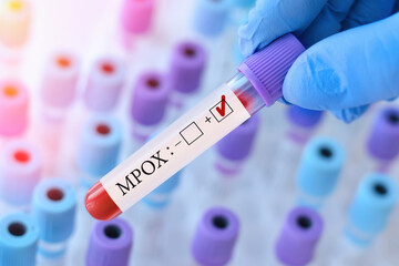 Doctor holding a test blood sample tube with Monkeypox virus (MPXV) .The virus is transmitted from...