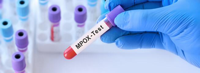Doctor holding a test blood sample tube with Monkeypox virus (MPXV) .The virus is transmitted from...
