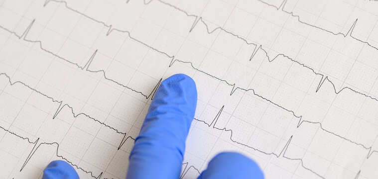 Wykres pracy serca na papierowym wydruku z badania EKG, medycyna sportowa, choroby serca 