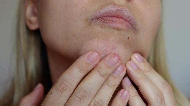 Young woman showing comedones on her chin touching with hands. Pimples, acne, black heads, hormonal changes. Problem skin, care and beauty concept. Dermatology, cosmetology concept