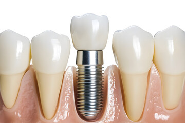 Jaw with gums and teeth and dental implant screws. Dental implant process, 3D illustration on white background