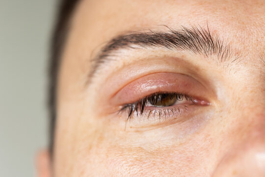 Swollen left eye with chalazion upper eyelid in the eye. concept disease eyelids manifests itself tumor. Benign formation rounded shape thickness eyelid. formed when meibomian gland duct is blocked