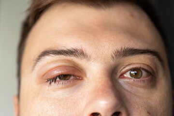 inflamed eye gives idea visible symptoms of bacterial eye infections. chalazion or chalazion chronic proliferative inflammation of the eyelid margin around the meibomian gland or Zeiss gland