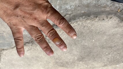 Fototapeta premium Blisters on the finger due to rubbing with hot water or being exposed to heat on the skin, risking infection. Burn Management 