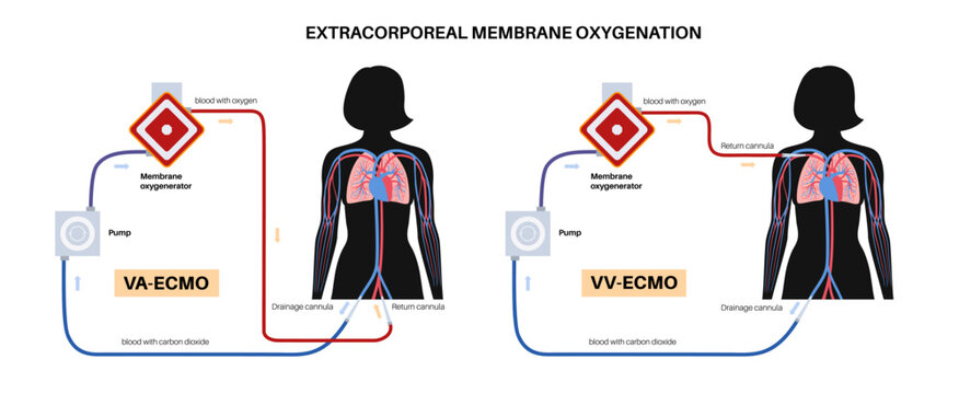 Extracorporeal membrane oxygenation