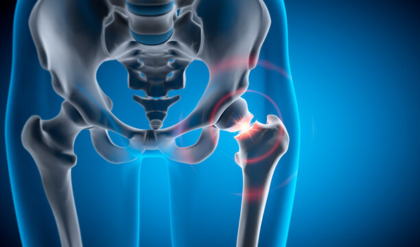 Medical 3D illustration of a hip joint with fracture - 3D illustration
