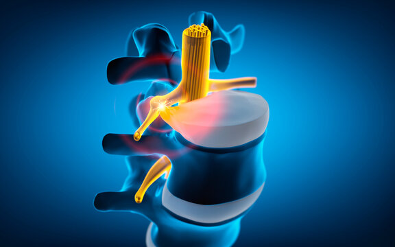 Part of human spine with spinal cord under pressure of intervertebral disc