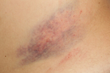 Fototapeta premium Close up view of a nasty bruise
