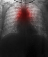 Chest x-ray of a man having a heart attack and highlighted with a red spot, heart attack