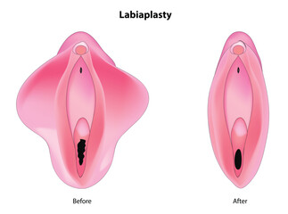Labiaplasty (plastic surgery procedure for creating or altering the labia minora and the labia majora)