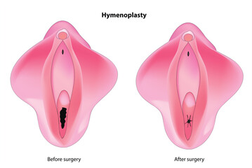 Hymenoplasty