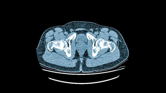 Transverse view or axial plain of CT chest showing normal study of heart, lungs, spine, rib, other. MRI scan of the chest. Magnetic resonance imaging scan