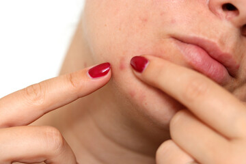 Close up of female face with red problematic acne skin and scars