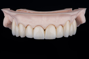 High-quality frontal dental bridge of 10 upper teeth made of zirconium for fixation to upper jaw.