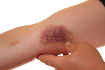 Woman with bruise on arm against white background, closeup