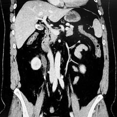 CT of Kidney Stone