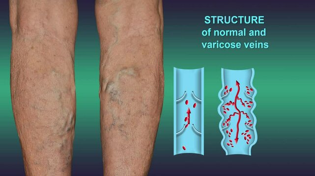 Deep Vein Thrombosis or Blood Clots. Embolus. Structure of normal and varicose female veins - 2D animation