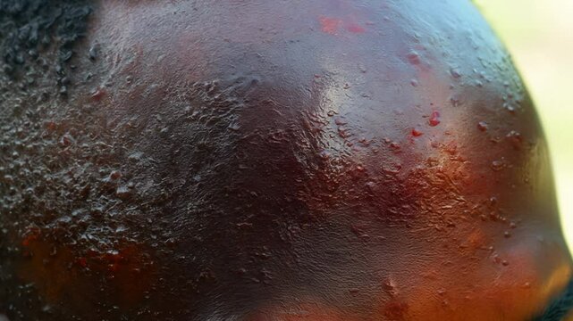 A close-up of a black male face showing the early stages of monkeypox, with red, raised lesions spreading across the cheeks and forehead, emphasizing the initial symptoms of the disease.