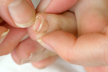 woman trims her nails with a special tool at home, closeup