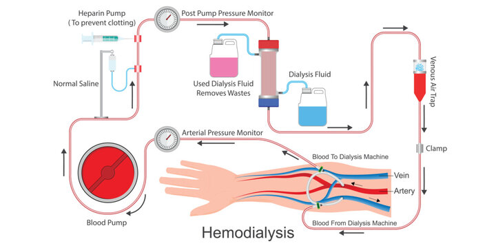 Hemodialysis is a treatment to filter wastes and water.