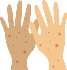 Transparent infected person's hands with Orthopoxvirus Mpox monkeypox virus. Illustration of visible rash and red lesions symptoms of the Monkeypox virus.