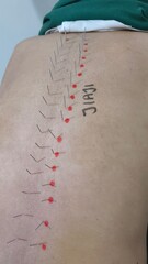 people are undergoing acupuncture therapy