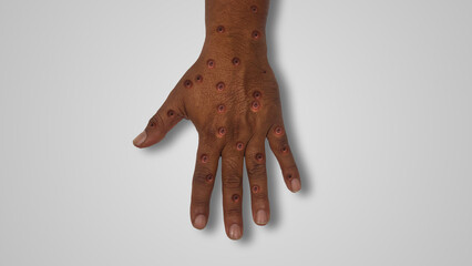 Hand Acquired Viral Monkeypox Lesion Syndrome